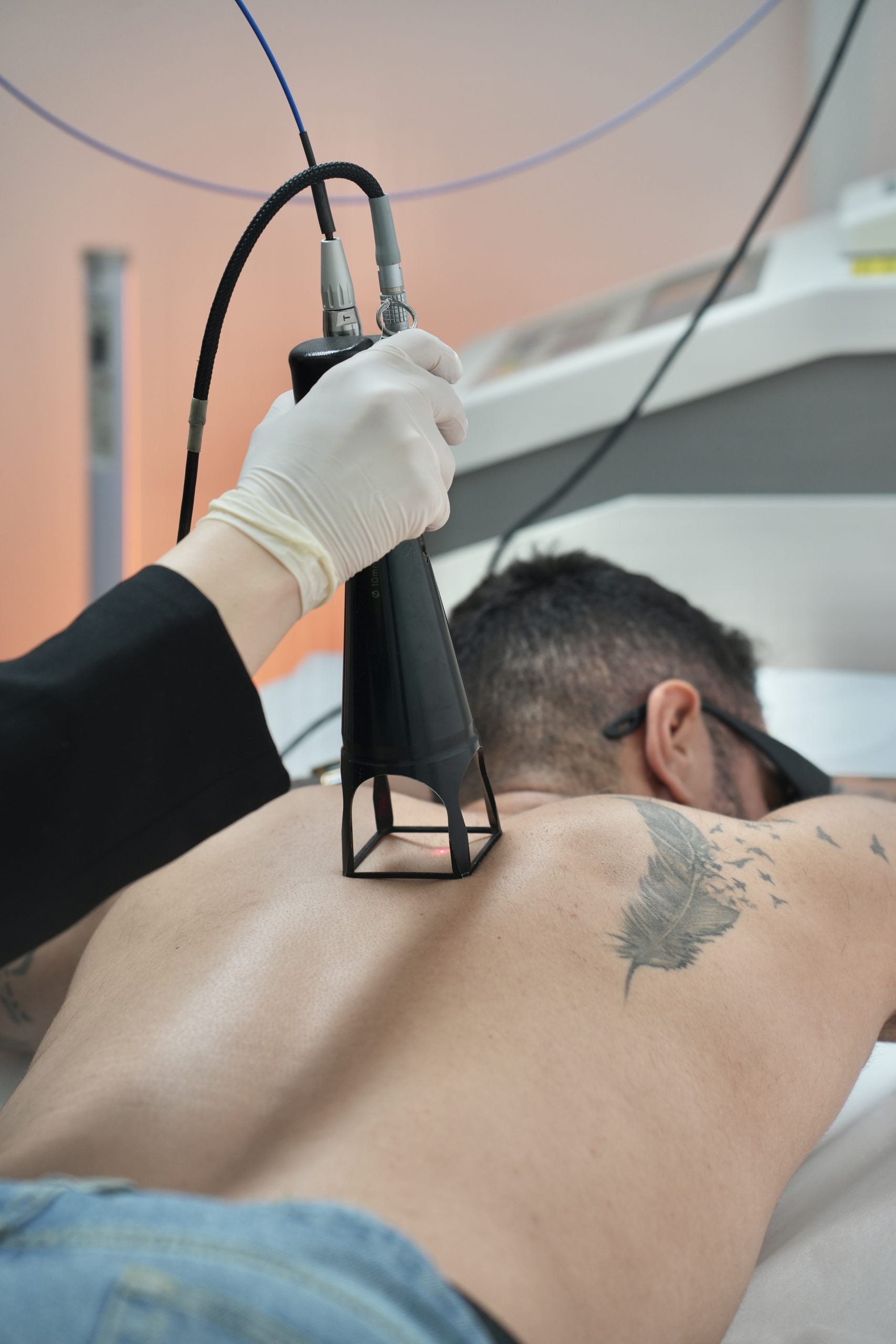 הסרת שיער בלייזר