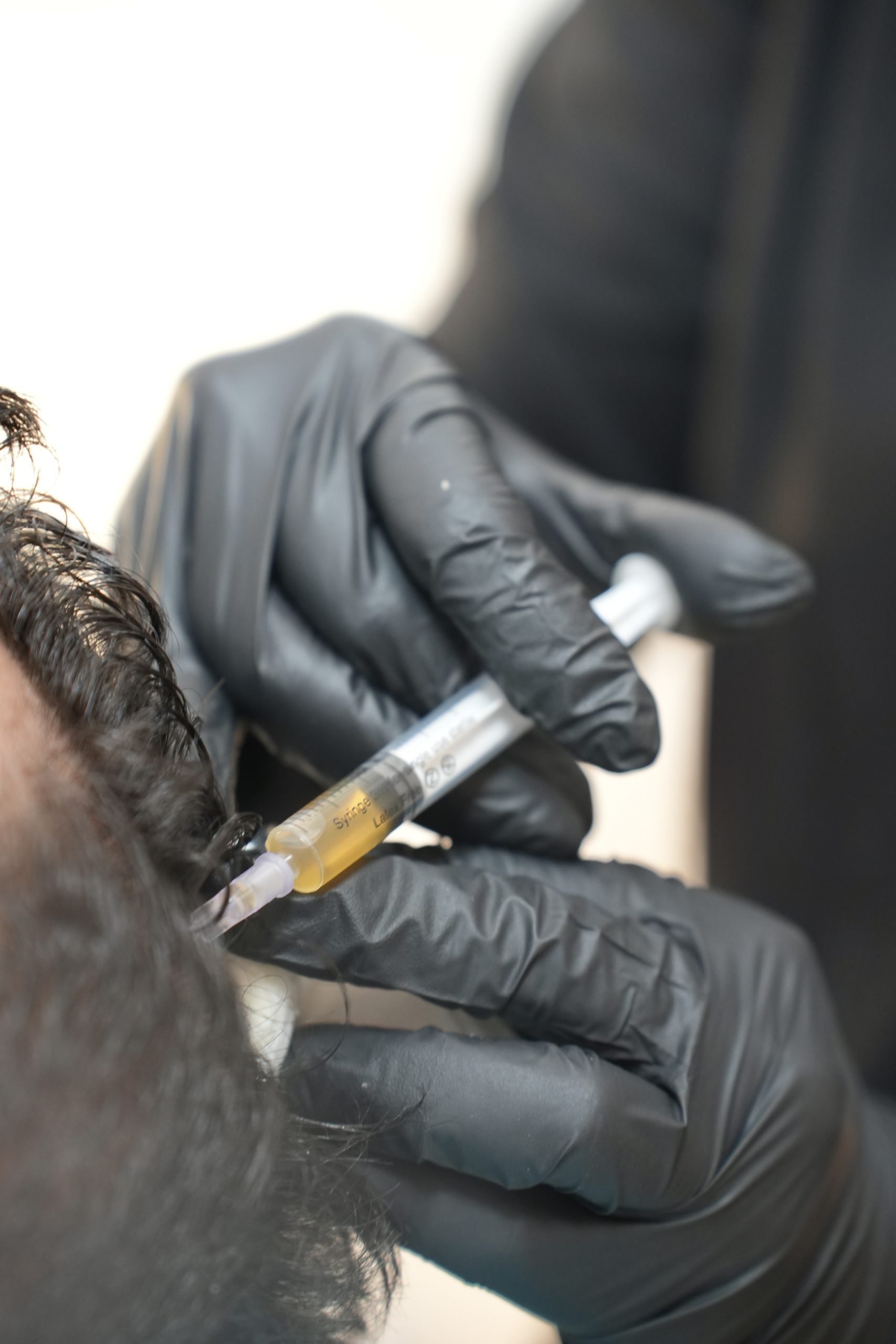 PRP לאחר השתלת שיער — שיקום מואץ