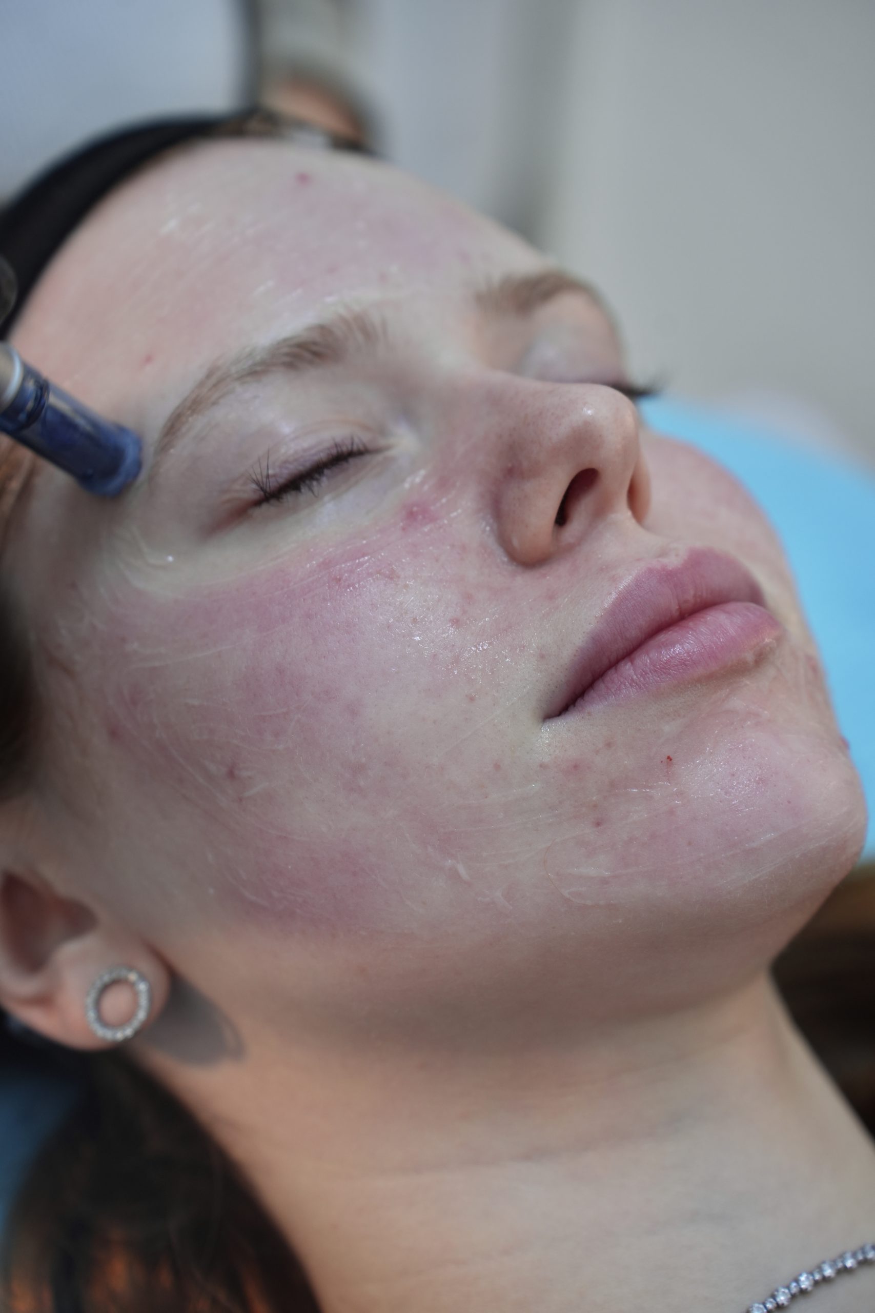 PRP לחידוש עור הפנים — ״ערפד פייסליפט״